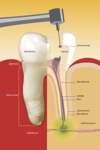 Wurden früher durch eine Wurzelentzündung stark geschädigte Zähne gezogen, werden heute die Bakterien vollständig entfernt, um den Zahn zu erhalten.