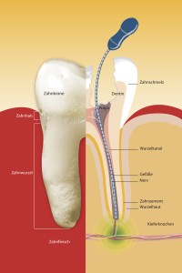 Wurden früher durch eine Wurzelentzündung stark geschädigte Zähne gezogen, werden heute die Bakterien vollständig entfernt, um den Zahn zu erhalten.